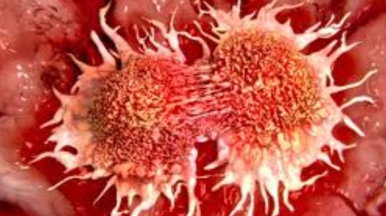 Evolving cancer trends present challenges for life and health insurers